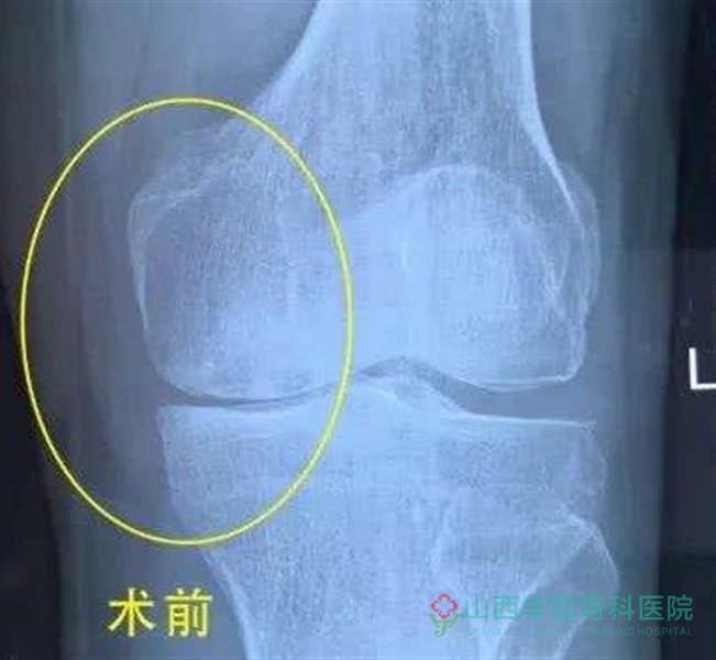 膝关节单髁置换术前