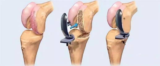 膝关节置换手术费用图片